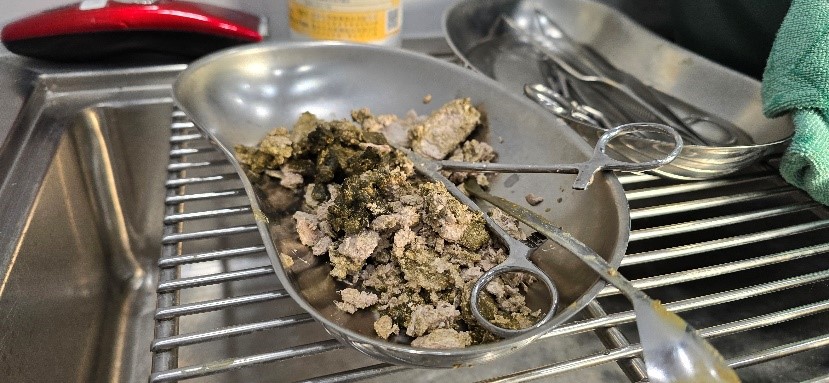 A large number of calculi in Case 2 were removed during the surgery