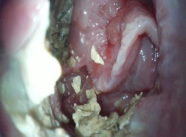 Multiple areas of localized erythema and edema are visible on the mucosal surface of the cloaca of Case 3