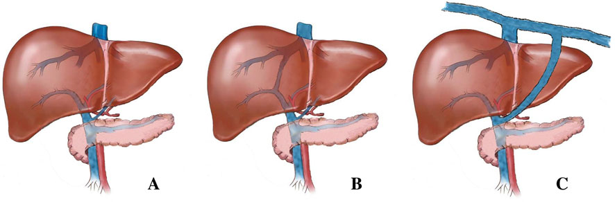 Overview of the anatomy of a normal liver and of livers with intra-and extrahepatic portosystemic shunts